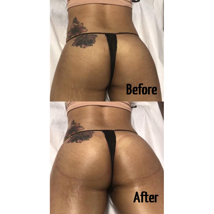 Butt Enhancement is a Cosmetic Service Offered by Innovative Aesthetics Skincare