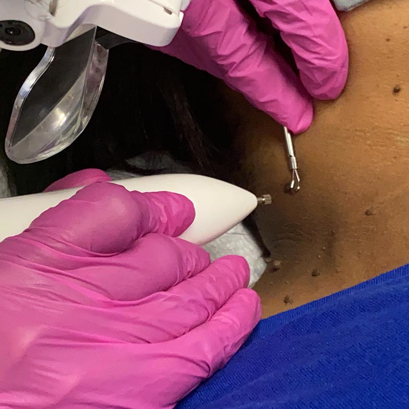 Skin Tag Removal is a Cosmetic Service Offered by Innovative Aesthetics Skincare